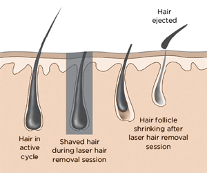 Professional Laser Hair Removal Service| permanent facial Treatments Grapevine TX Professional Laser Hair Removal Service| permanent facial Treatments Grapevine TX